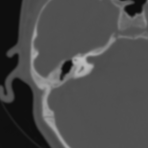 Bilateral otosclerosis (Radiopaedia 57237-64157 B 73).jpg