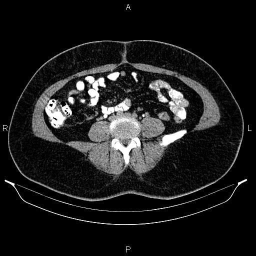 Bilateral ovarian dermoid cysts (Radiopaedia 85785-101603 Axial C+ delayed 47).jpg