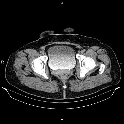Bilateral ovarian dermoid cysts (Radiopaedia 85785-101603 Axial C+ delayed 83).jpg