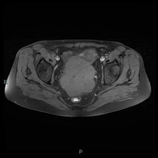 File:Bilateral ovarian fibroma (Radiopaedia 44568-48293 Axial T1 fat sat 17).jpg
