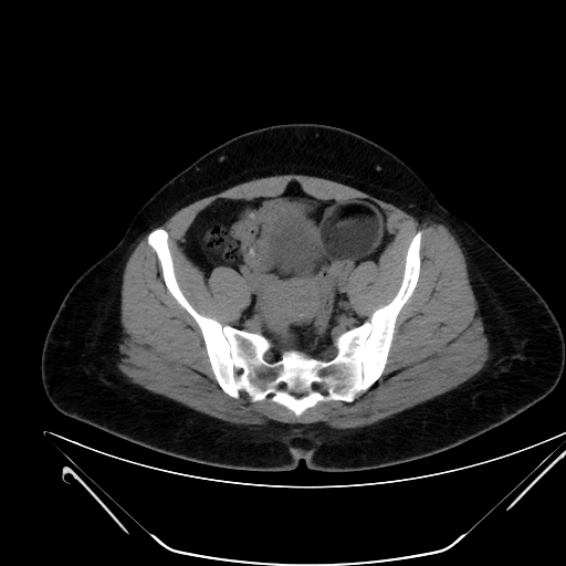 File:Bilateral ovarian mature cystic teratomas (Radiopaedia 79373-92457 Axial non-contrast 56).jpg