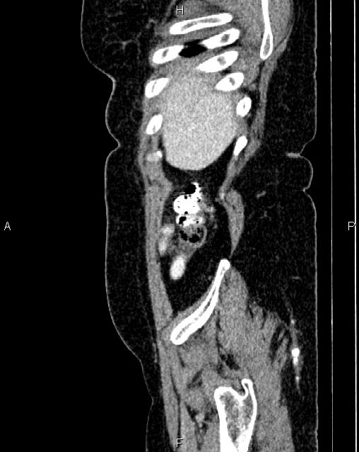 Bilateral ovarian serous cystadenocarcinoma (Radiopaedia 86062-101989 E 6).jpg