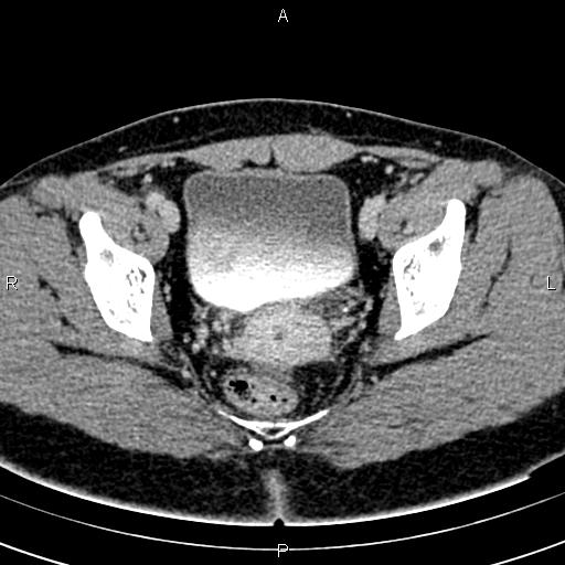 Bilateral ovarian teratoma (Radiopaedia 83131-97503 B 55).jpg