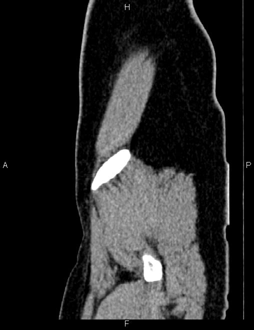 Bilateral ovarian teratoma (Radiopaedia 83131-97503 D 18).jpg