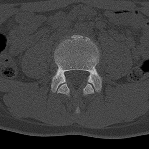 Bilateral pars defect (Radiopaedia 26691-26846 Axial bone window 22).jpg
