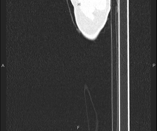 Bilateral pulmonary AVM (Radiopaedia 83134-97505 Sagittal lung window 124).jpg
