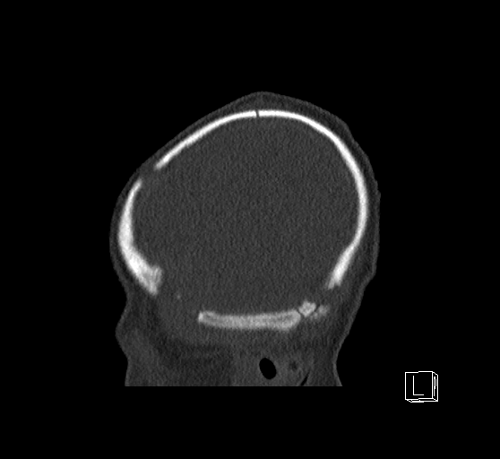 Bilateral subdural hemorrhage and parietal skull fracture (Radiopaedia 26058-26192 Sagittal bone window 86).png