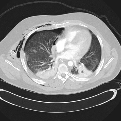 Bilateral traumatic renovascular injury (Radiopaedia 32051-32995 Axial lung window 30).jpg