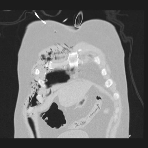 Bilateral traumatic renovascular injury (Radiopaedia 32051-32995 Coronal lung window 11).jpg