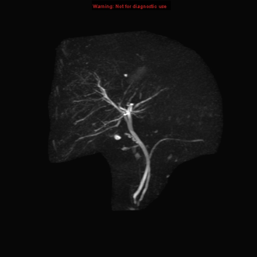 File:Biliary tree anatomical variant - biliary trifurcation (Radiopaedia 12531-12750 Coronal 3D MRCP 9).jpg