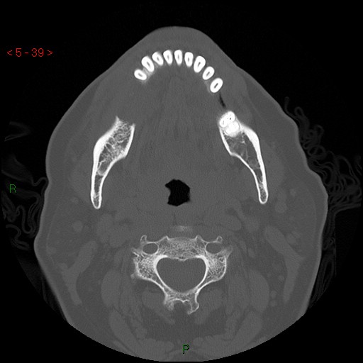 Bisphosphonate-related osteonecrosis of the jaw (Radiopaedia 54147-60329 Axial bone window 33).jpg