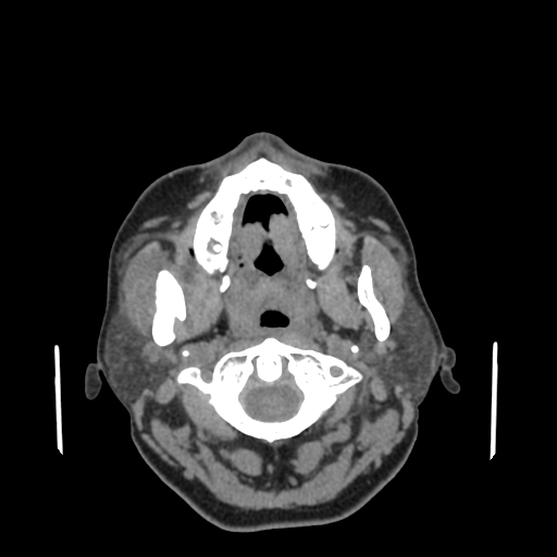 Bisphosphonate-related osteonecrosis of the jaw (Radiopaedia 71324-81642 non-contrast 107).jpg