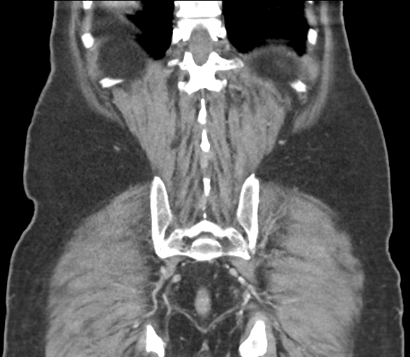 File:Bladder papillary urothelial carcinoma (Radiopaedia 48119-52951 C 54).png