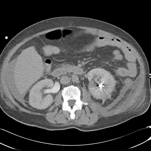 Bladder rupture post renal biopsy (Radiopaedia 30863-31572 Axial non-contrast 40).jpg