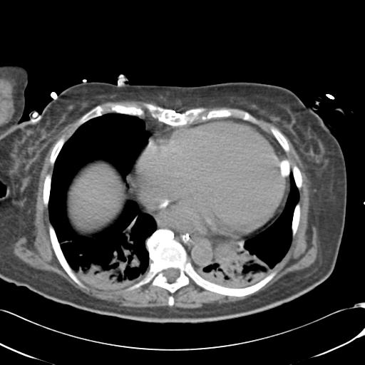 Bladder rupture post renal biopsy (Radiopaedia 30863-31572 Axial non-contrast 5).jpg