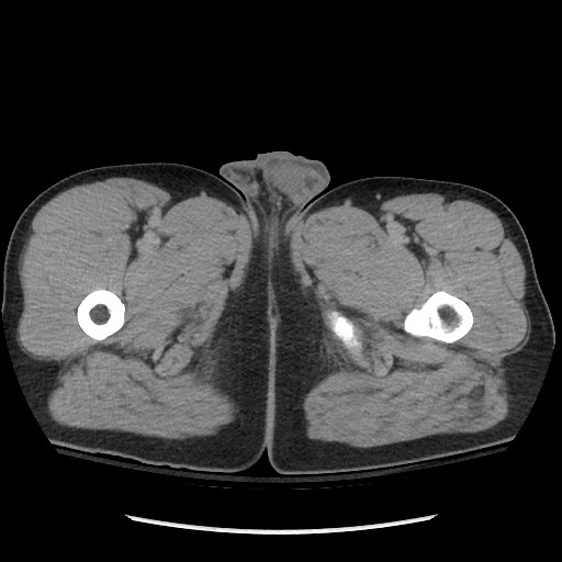 File:Blunt abdominal trauma with solid organ and musculoskelatal injury with active extravasation (Radiopaedia 68364-77895 Axial C+ delayed 157).jpg