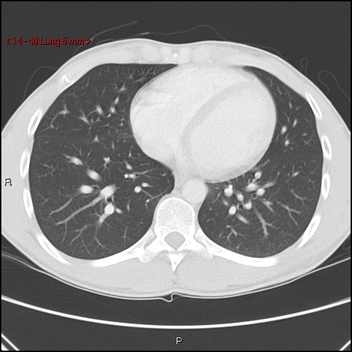 Blunt chest trauma - pulmonary interstitial emphysema and pneumomediastinum (Radiopaedia 20666-20552 Axial lung window 40).jpg