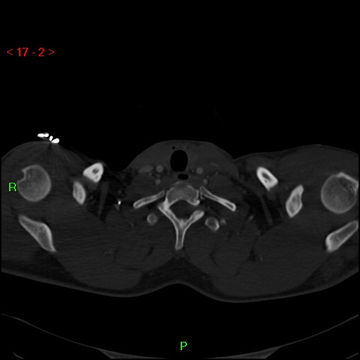 Blunt thoracic trauma (Radiopaedia 73454-84221 Axial bone window 2).jpg