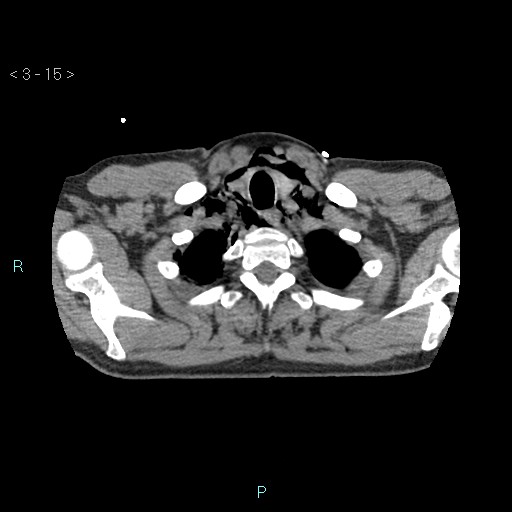 Boerhaave syndrome (Radiopaedia 27683-27897 oral contrast 15).jpg