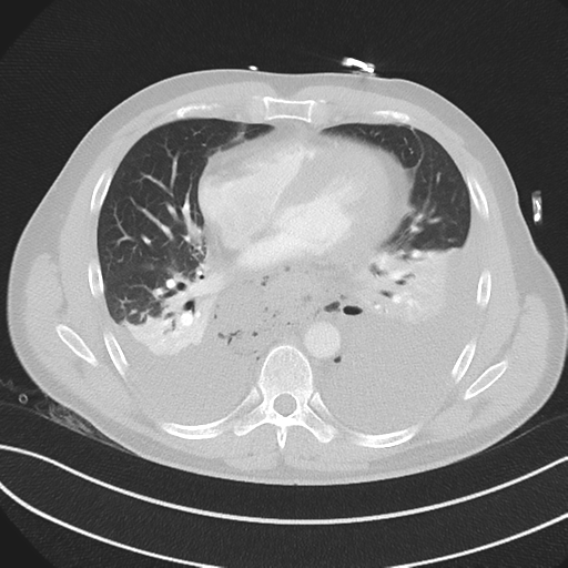 File:Boerhaave syndrome (Radiopaedia 39382-41660 Axial lung window 34).png
