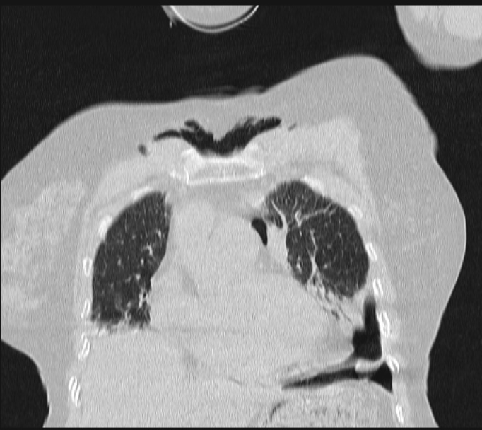 Boerhaave syndrome (Radiopaedia 45644-49799 Coronal lung window 20).jpg