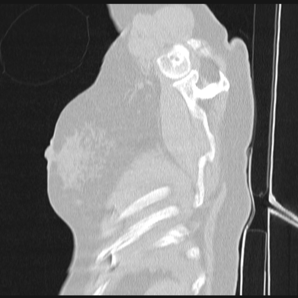 Boerhaave syndrome (Radiopaedia 45644-49799 Sagittal lung window 83).jpg