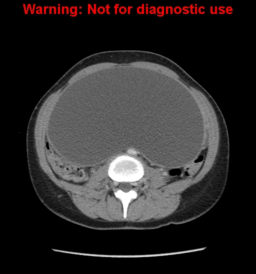 Borderline mucinous cystadenoma of ovary (Radiopaedia 25586-25767 A 36).jpg