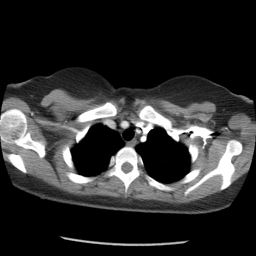 File:Borderline mucinous tumor (ovary) (Radiopaedia 78228-90808 A 9).jpg