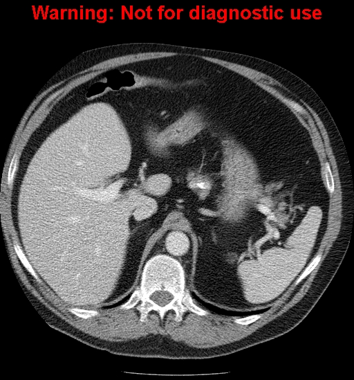 File:Bosniak renal cyst - type IV (Radiopaedia 23402-23466 D 16).jpg