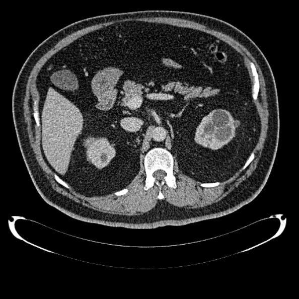 File:Bosniak renal cyst - type IV (Radiopaedia 24244-24518 C 111).jpg