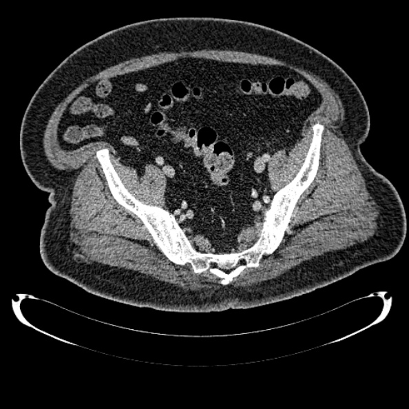 Bosniak renal cyst - type IV (Radiopaedia 24244-24518 C 327).jpg