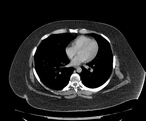 Bowel and splenic infarcts in acute lymphocytic leukemia (Radiopaedia 61055-68913 A 7).jpg