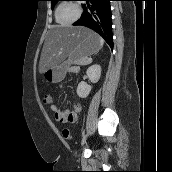 Bowel and splenic infarcts in acute lymphocytic leukemia (Radiopaedia 61055-68913 C 33).jpg