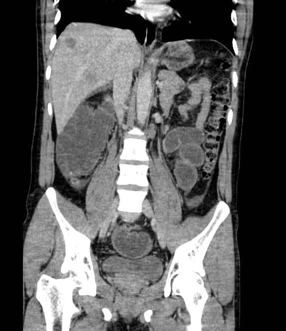 Bowel obstruction from colon carcinoma (Radiopaedia 22995-23028 C 42).jpg