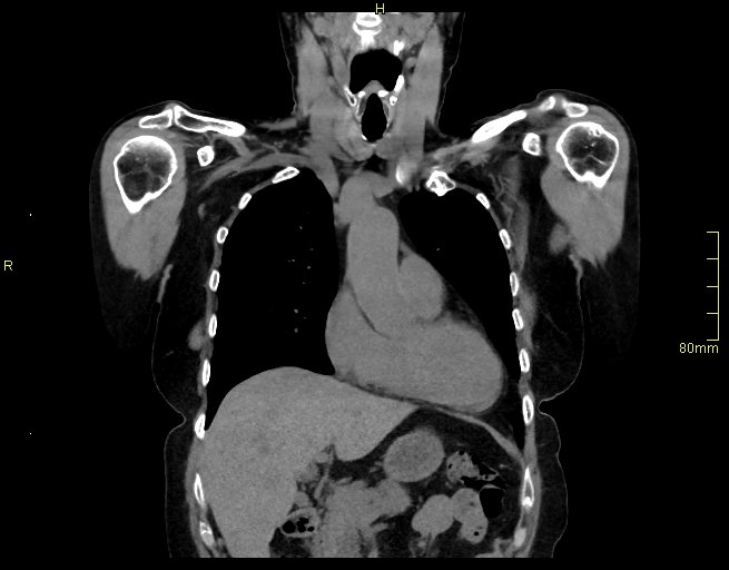 Brachial artery foreign body (Radiopaedia 54583-60820 Coronal non-contrast 19).jpg