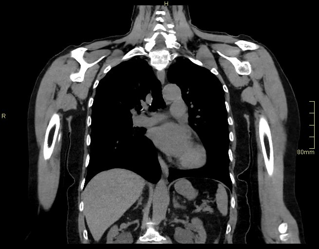Brachial artery foreign body (Radiopaedia 54583-60820 Coronal non-contrast 31).jpg