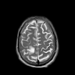 File:Brain abscess complicated by intraventricular rupture and ventriculitis (Radiopaedia 82434-96571 Axial T2 21).jpg