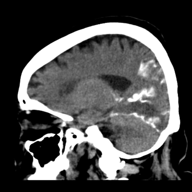 Brain cortical laminar necrosis (Radiopaedia 25822-25971 non-contrast 32).jpg
