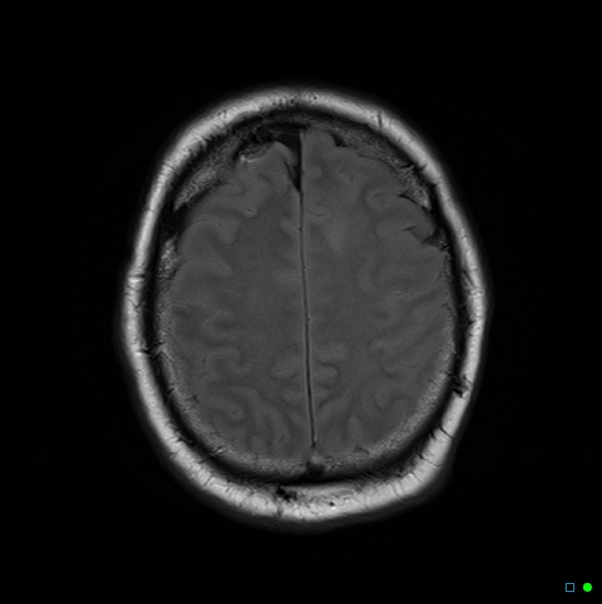 File:Brain death on MRI and CT angiography (Radiopaedia 42560-45689 Axial FLAIR 13).jpg