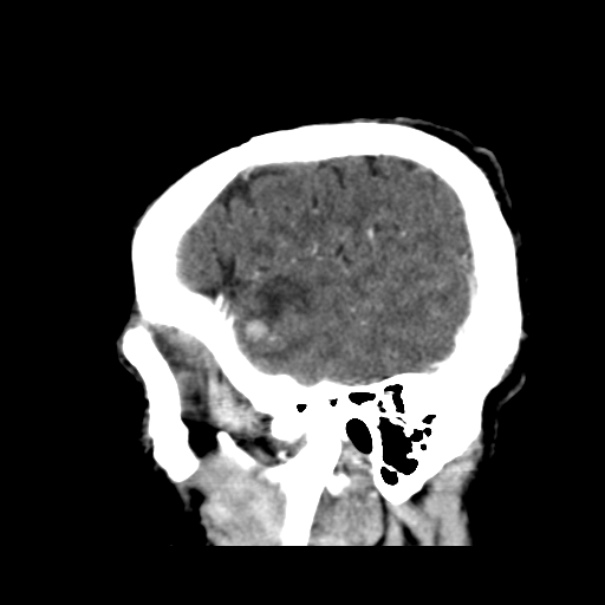 Brain metastases from lung cancer (Radiopaedia 24480-24781 C+ delayed 49).jpg