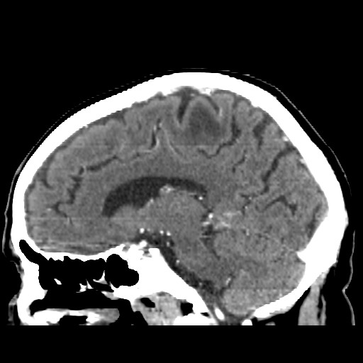 Brain metastasis (Radiopaedia 42617-45760 D 31).jpg