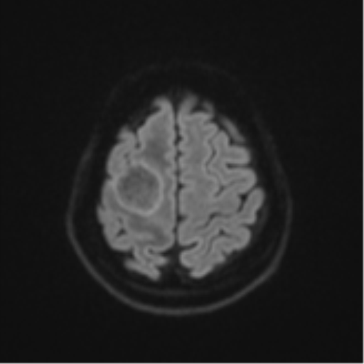 Brain metastasis (sarcoma) (Radiopaedia 47576-52209 Axial DWI 50).png