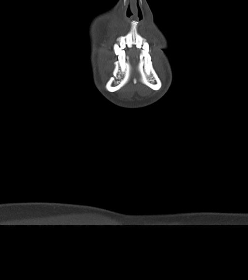 Branchial cleft cyst (Radiopaedia 31167-31875 Coronal bone window 10).jpg