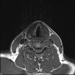 File:Branchial cleft cyst (Radiopaedia 31167-31876 Axial T1 2).jpg