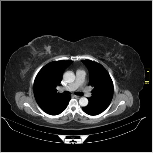 File:Breast cancer on thorax CT (Radiopaedia 60571-68275 A 44).JPG