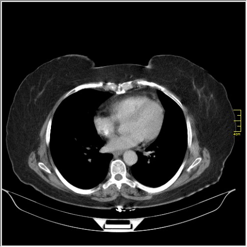Breast cancer on thorax CT (Radiopaedia 60571-68275 A 63).JPG