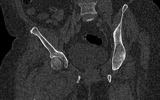 Breast carcinoma with pathological hip fracture (Radiopaedia 60314-67993 Coronal bone window 69).jpg