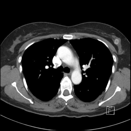 File:Breast metastases from renal cell cancer (Radiopaedia 79220-92225 A 36).jpg