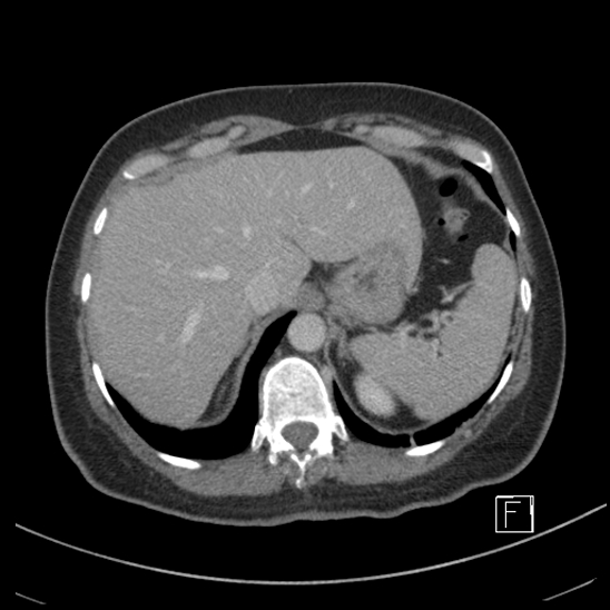 Breast metastases from renal cell cancer (Radiopaedia 79220-92225 C 16).jpg