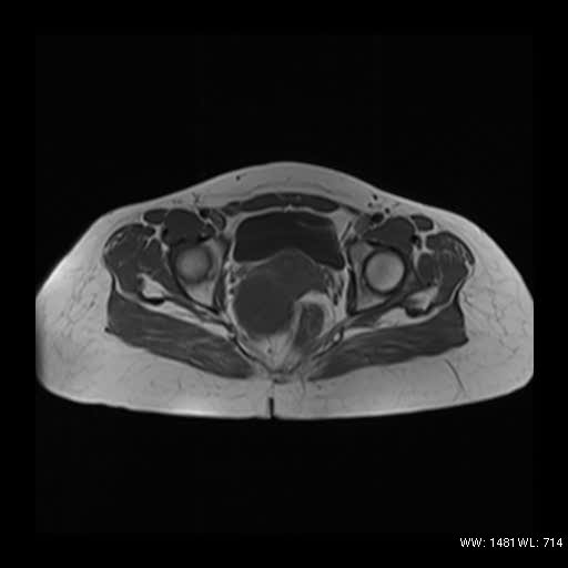 File:Broad ligament fibroid (Radiopaedia 49135-54241 Axial T1 12).jpg